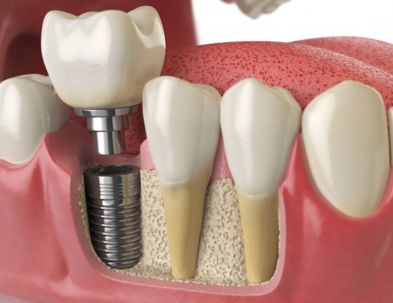 От чего зависит цена на протезирование зубов в 2023 году?