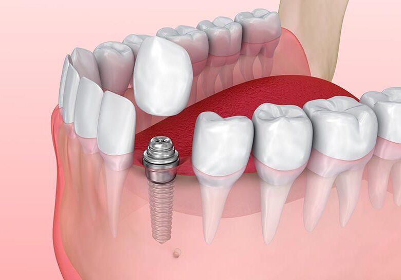 Повна імплантація зубів — як отримати якісний результат на довгі роки?