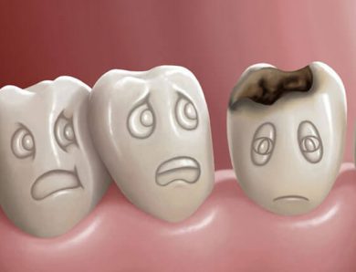 Чому важливо лікувати карієс та як обрати стоматологію в Києві для лікування зубів